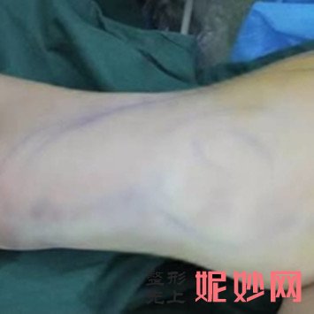 南京华美手臂抽脂多少钱