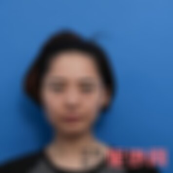 南京华美去眼袋怎么样