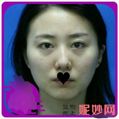 南京华美打水光*多少钱