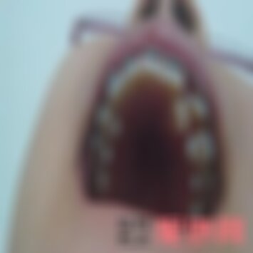 绵阳茗汇齿科拔智齿多少钱一颗