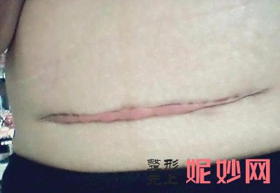 绵阳茗汇整形医院能去疤吗