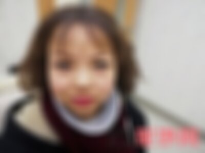 洛阳毛大夫光子嫩肤怎么样
