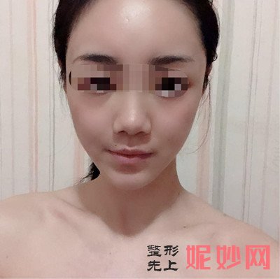 洛阳毛大夫面部脂肪填充好不好