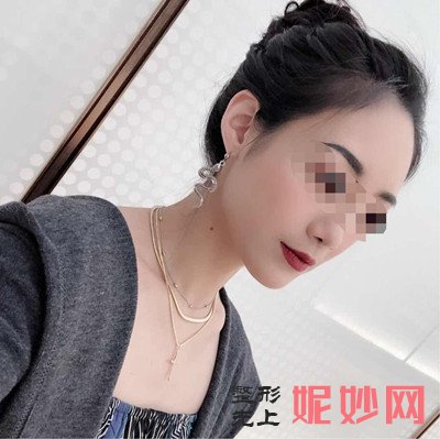 洛阳毛大夫面部脂肪填充好不好