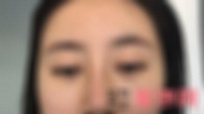 洛阳毛大夫割双眼皮怎么样