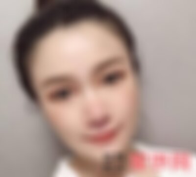 洛阳毛大夫割双眼皮怎么样