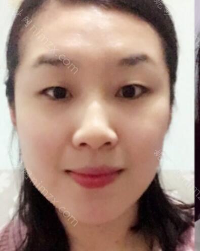 温州名人医疗美容医院邓建平做双眼皮效果好不好?附真人术后恢复效果图
