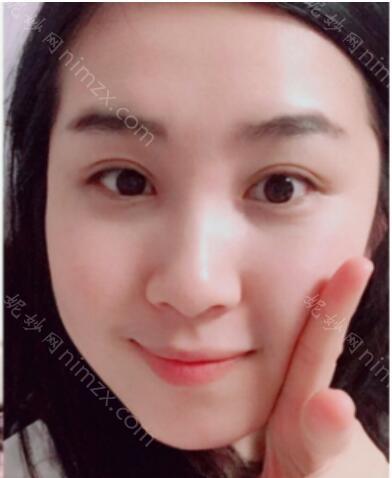 温州名人医疗美容医院邓建平做双眼皮效果好不好?附真人术后恢复效果图