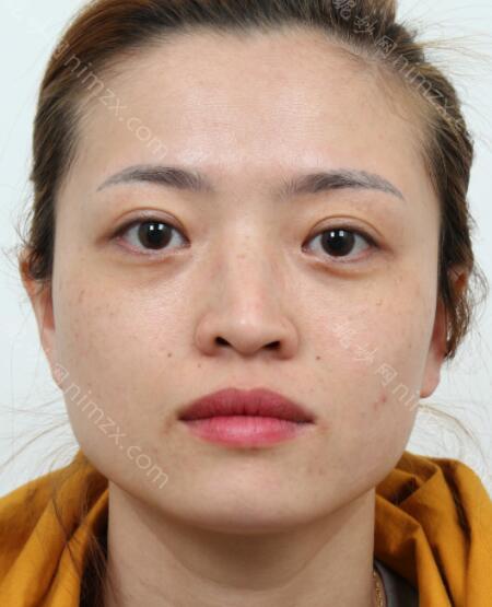 温州名人医疗美容医院赵进军做隆鼻效果怎么样?附术后对比图+价格表