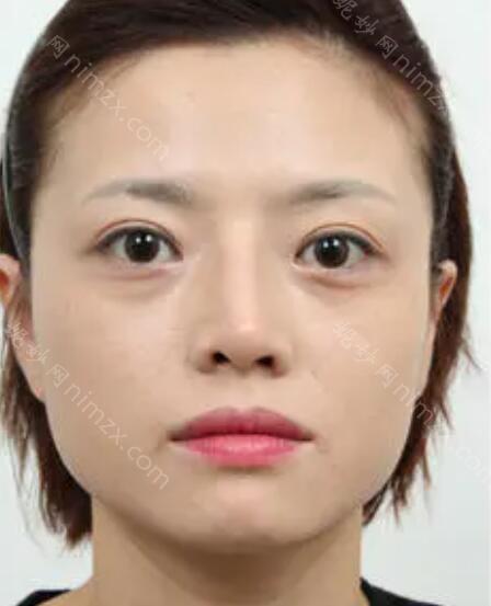 温州名人医疗美容医院赵进军做隆鼻效果怎么样?附术后对比图+价格表