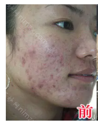 温州名人医疗美容医院项丽芳做微针祛痘效果怎么样?附案例分享+价格表