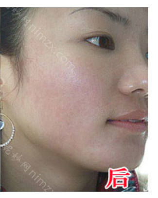 温州名人医疗美容医院项丽芳做微针祛痘效果怎么样?附案例分享+价格表