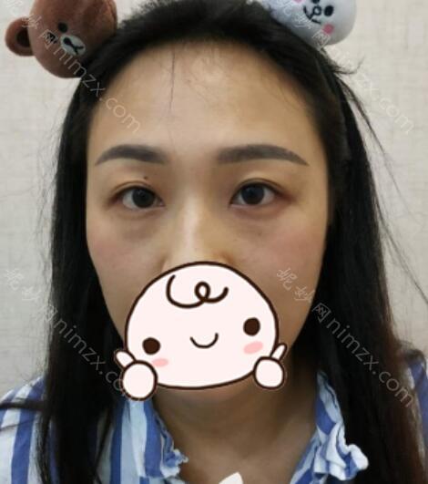 杭州艺星医疗美容医院张龙做鼻修复效果怎么样?附案例分享+价格表