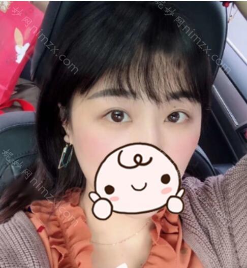 杭州艺星医疗美容医院张龙做鼻修复效果怎么样?附案例分享+价格表