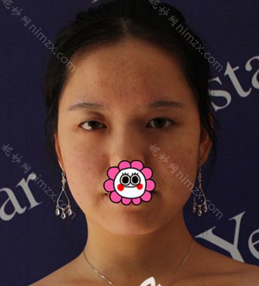 杭州艺星医疗美容医院钟冠鸿做玻尿酸填充隆鼻效果如何?附整形案例+价格表