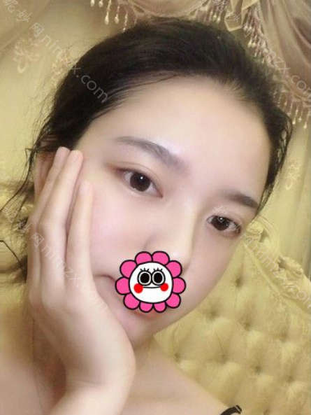 杭州艺星医疗美容医院钟冠鸿做玻尿酸填充隆鼻效果如何?附整形案例+价格表