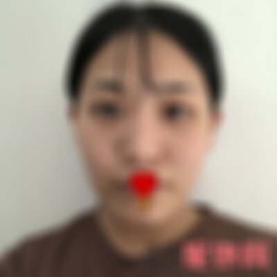 南充阿蓝医院激光祛痣好吗