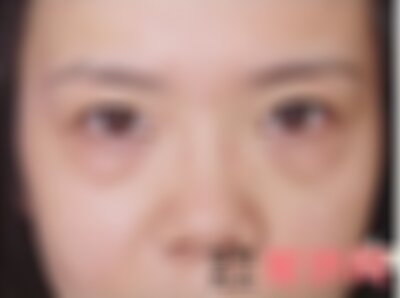 南充阿蓝整形做眼袋手术怎么样