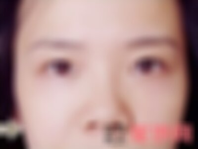 南充阿蓝整形做眼袋手术怎么样