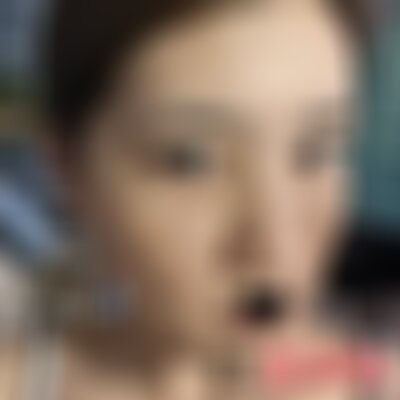 南充阿蓝医院做激光祛斑好吗