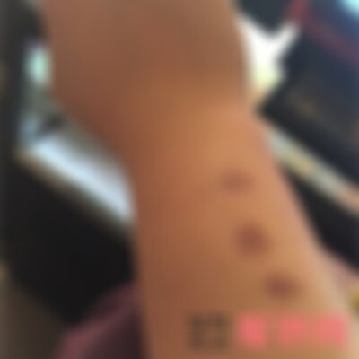 南充阿蓝整形修复烟疤做得好吗