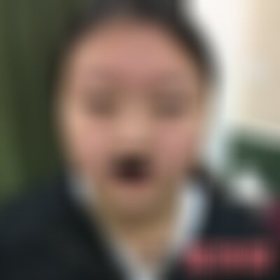 南充阿蓝整形隆鼻做得好不好