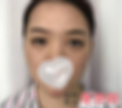 兰州皙妍丽做鼻综合怎么样