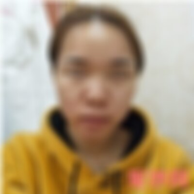 云南铜雀台治痘痘效果好吗