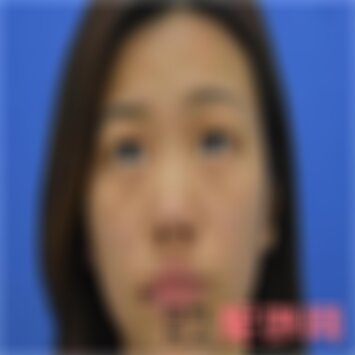 济南海峡整形去眼袋多少钱