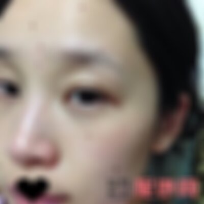 昆明艺星祛痣怎么样