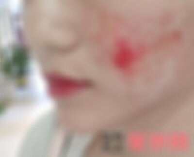 昆明艺星祛疤怎么样