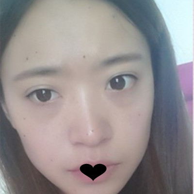 济南艺星祛痣怎么样