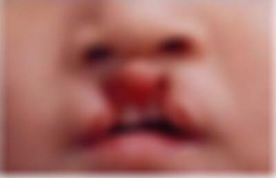 济南海峡唇腭裂修复做得好吗