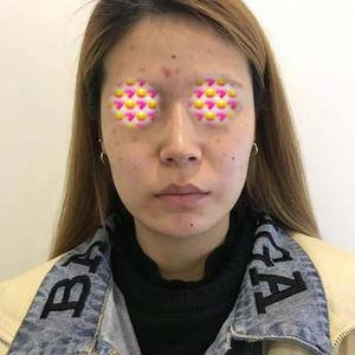 杭州格莱美医院祛痘效果好不好