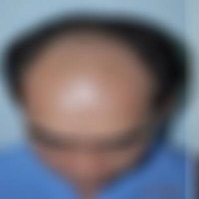 广州华美医疗美容医院植发怎么样