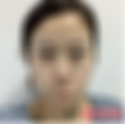 贵阳美莱医院做眼袋手术好不好