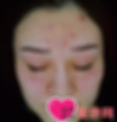 贵阳美莱医院祛斑怎么样