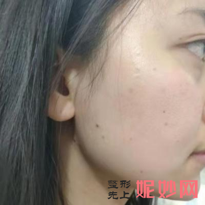 北京润美玉之光医院面部填充好吗