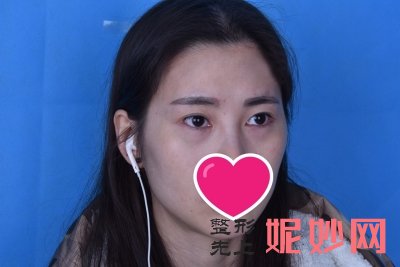 常州美莱谁做重睑术好吗