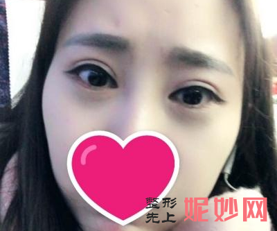常州美莱谁做重睑术好吗