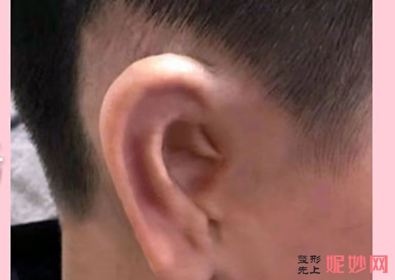 郑州耳畸形手术哪里做得好_手术技术怎么样？附案例！