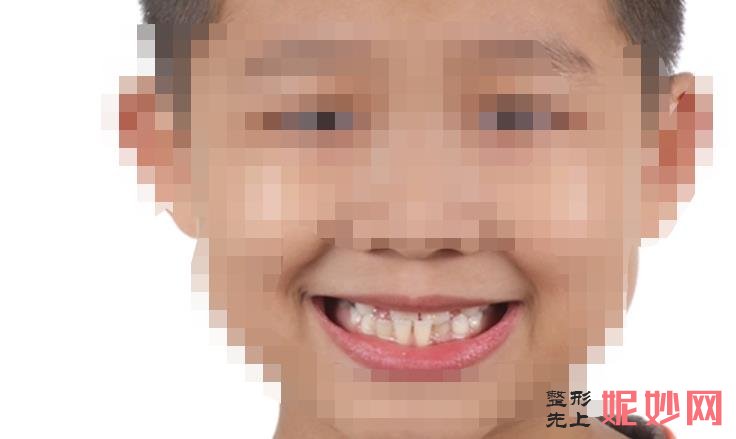 北大口腔正畸哪位专家好？正畸大概费用多少，附案例价格表！