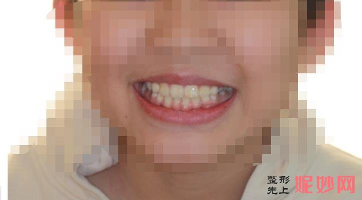 北大口腔正畸哪位专家好？正畸大概费用多少，附案例价格表！