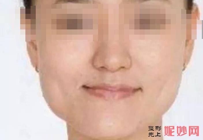 吴中兴下颌角手术怎么样？下颌角整形前后效果对比附价格表！