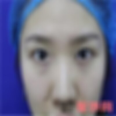 保定华美医疗美容医院去眼袋怎么样
