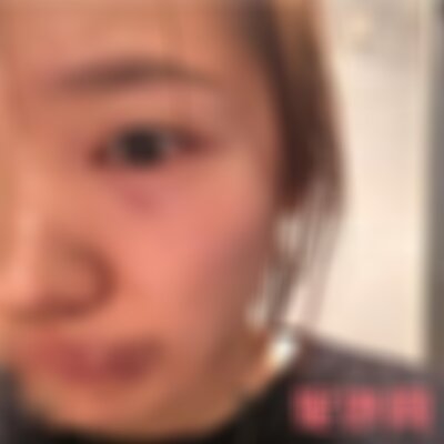 保定华美医疗美容医院去眼袋怎么样