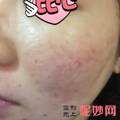 常州美莱激光祛痘价格多少钱