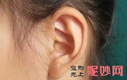 成都小耳畸形再造手术哪家医院好？效果怎么样？附案例！