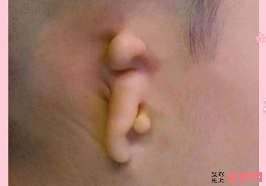 成都小耳畸形再造手术哪家医院好？效果怎么样？附案例！