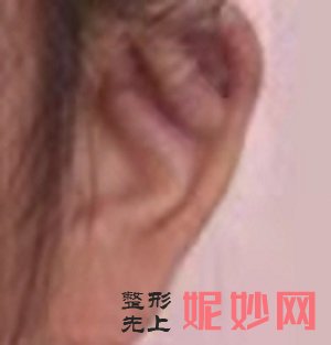 郑州小耳畸形整形医院怎么样，地址，价格